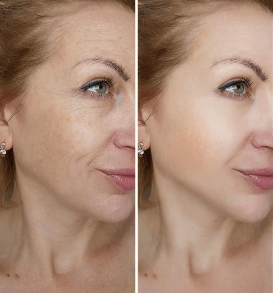 Anti Aging