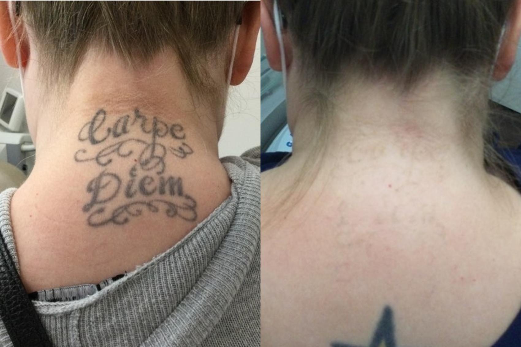 Tattoo Removal