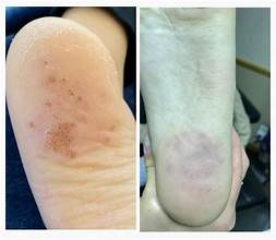 Warts Treatment